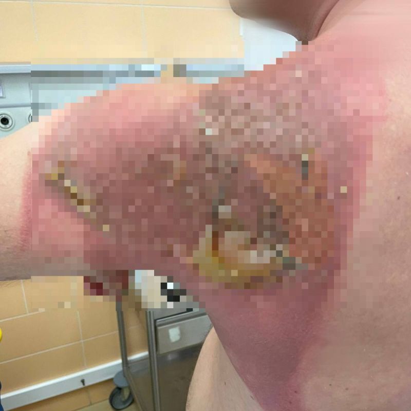 Житель Татарстана сжег спину до волдырей во время сна