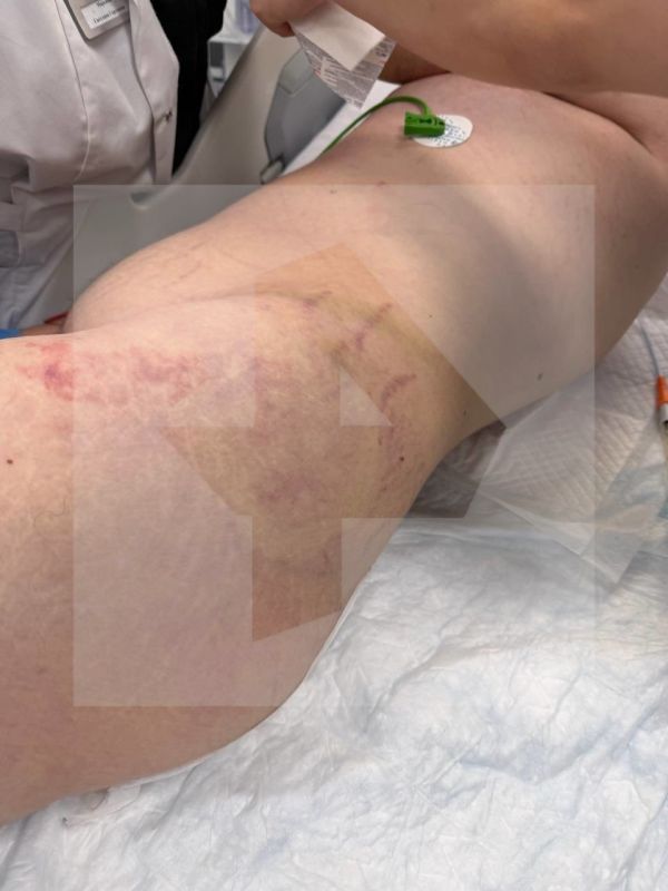 Ужасные гематомы, следы ударов и разрывы тканей обнаружены на теле 16-летнего воспитанника реабилитационного центра в Подмосковье Ужасные гематомы, следы ударов и разрывы тканей обнаружены на теле 16-летнего воспитанника реабилитационного центра в Подмосковье