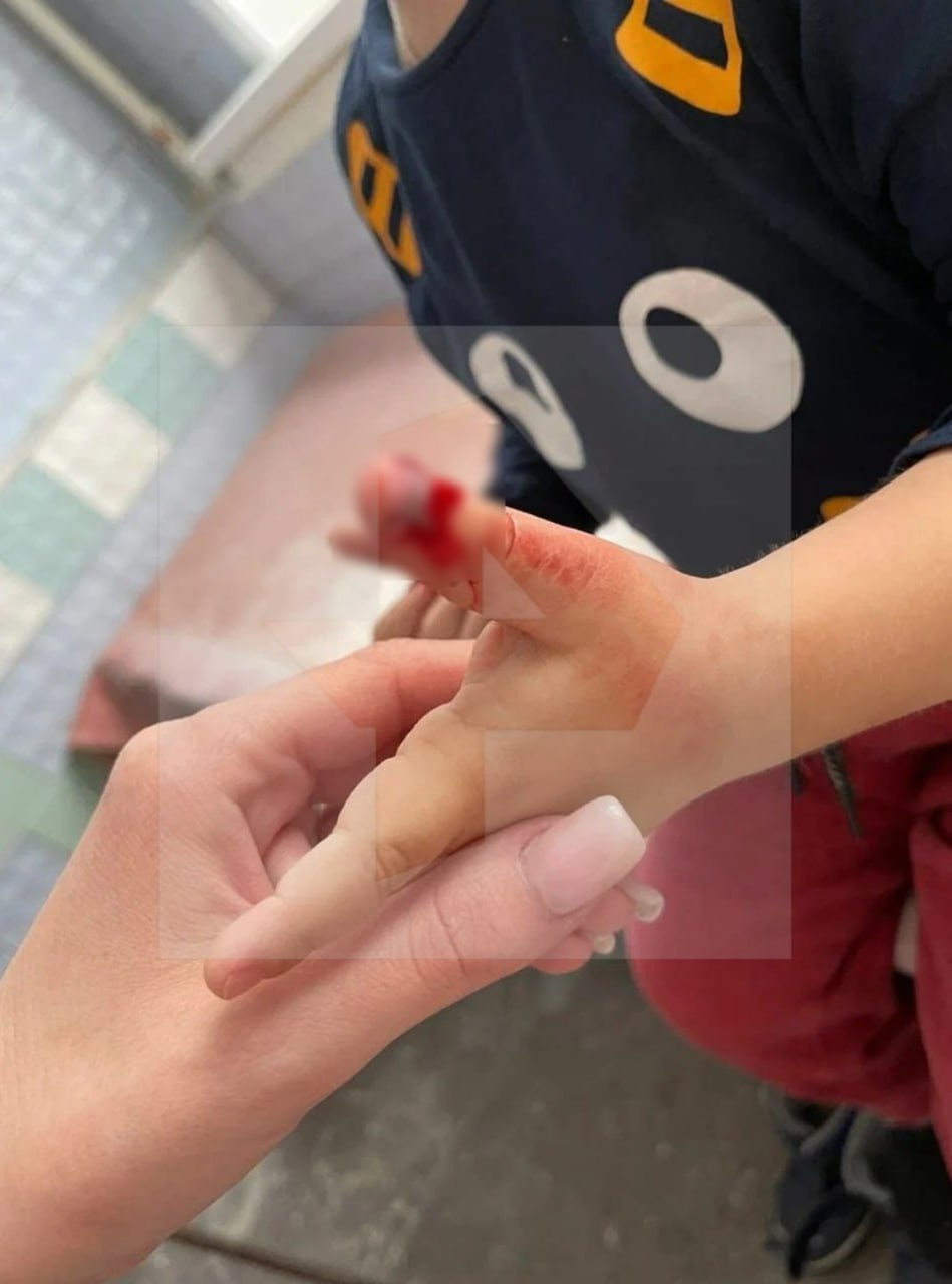 Сломанные пальцы, выбитые зубы и синяки: детей истязают в одном из детсадов Нижегородской области Сломанные пальцы, выбитые зубы и синяки: детей истязают в одном из детсадов Нижегородской области