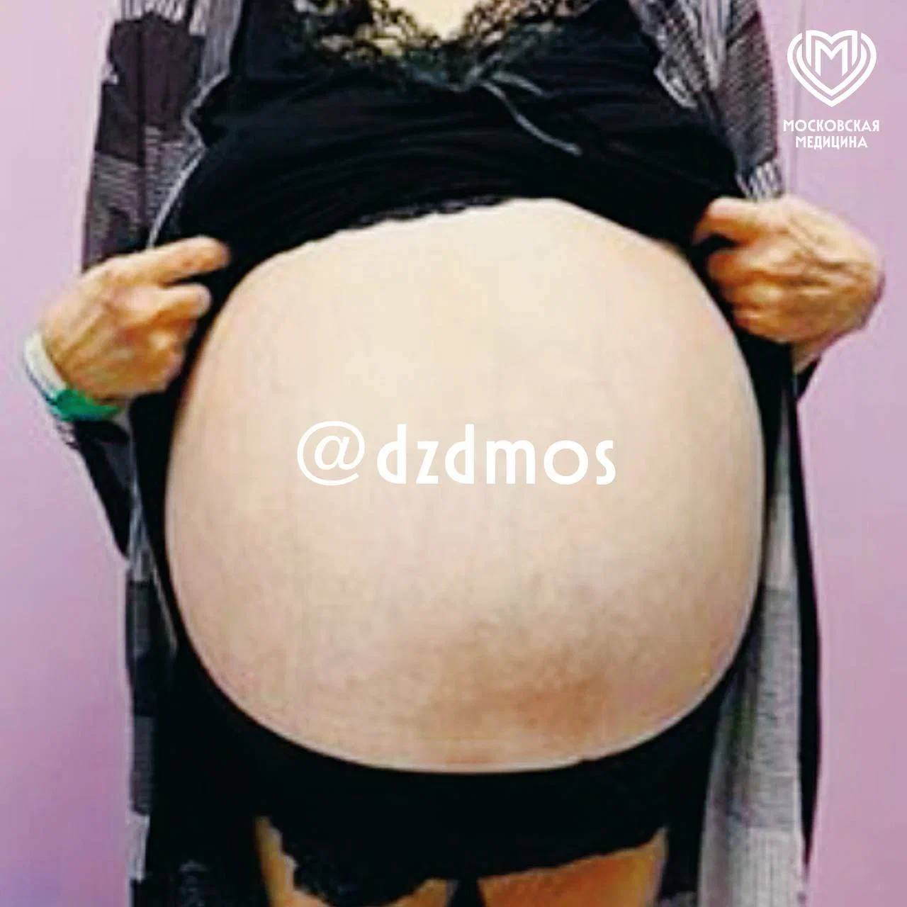 От опухоли яичника весом более 30 кг избавили пациентку московские акушеры-гинекологи