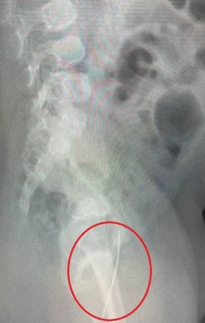 Врачи достали швейную иголку из годовалого ребёнка