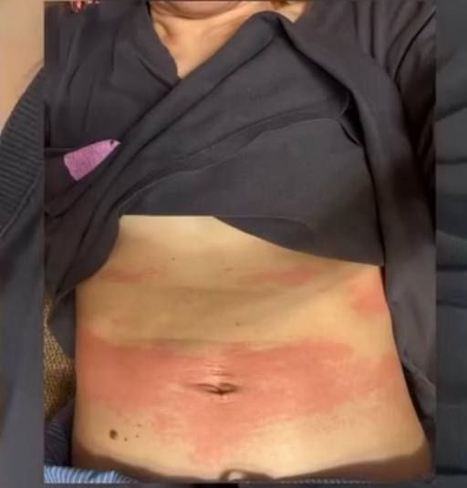 Пострадавшая от шоколада в Москве девушка рассказала РЕН ТВ, что ее "обсыпало" из-за личной реакции на некоторые составляющие продукта