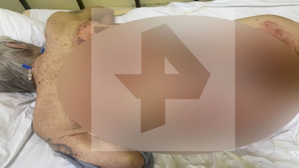 Мужчина "сварился" в кипятке, принимая ванну в Обнинске