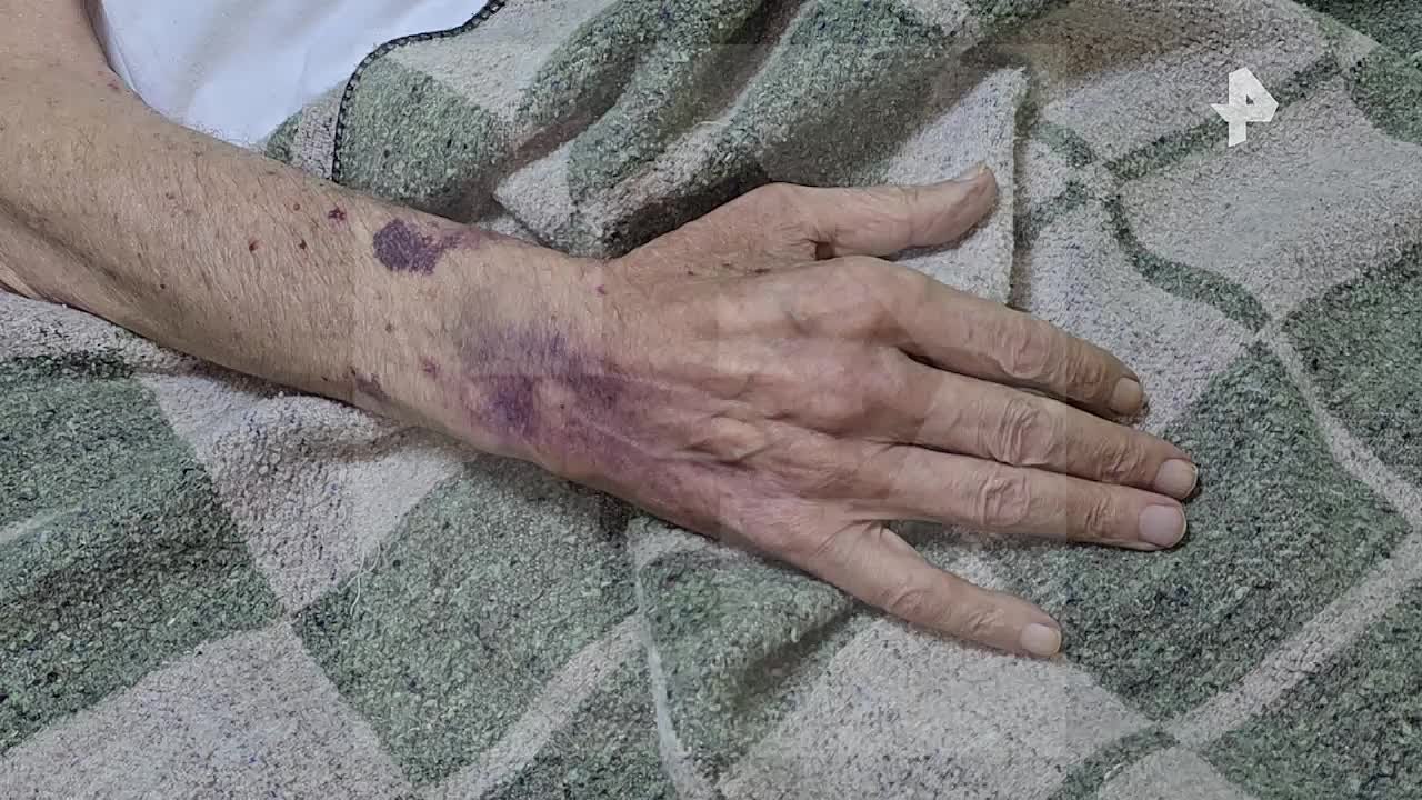 У мужчины, "сварившегося" в кипятке в ванной в Обнинске, после случившегося появились галлюцинации, рассказала РЕН ТВ дочь пострадавшего