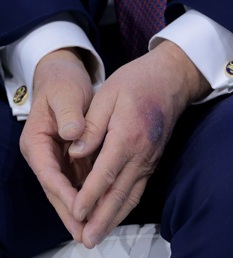 У Трампа в Давосе заметили синяк на руке