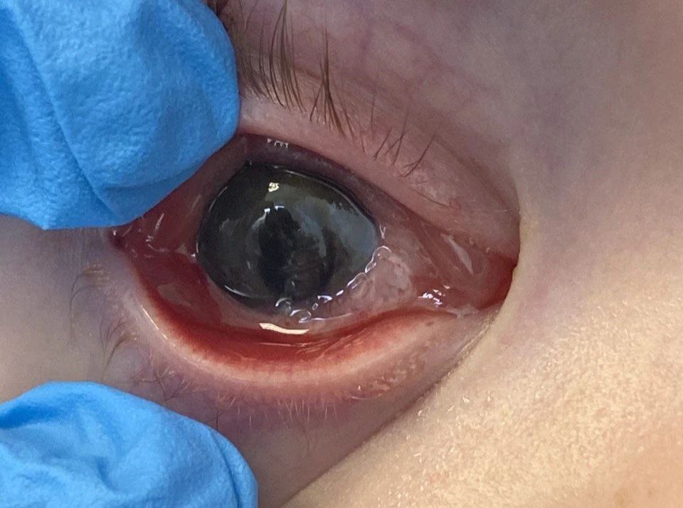 Малышу с ножевым ранением глаза владивостокские офтальмологи подарили надежду на полноценное зрение